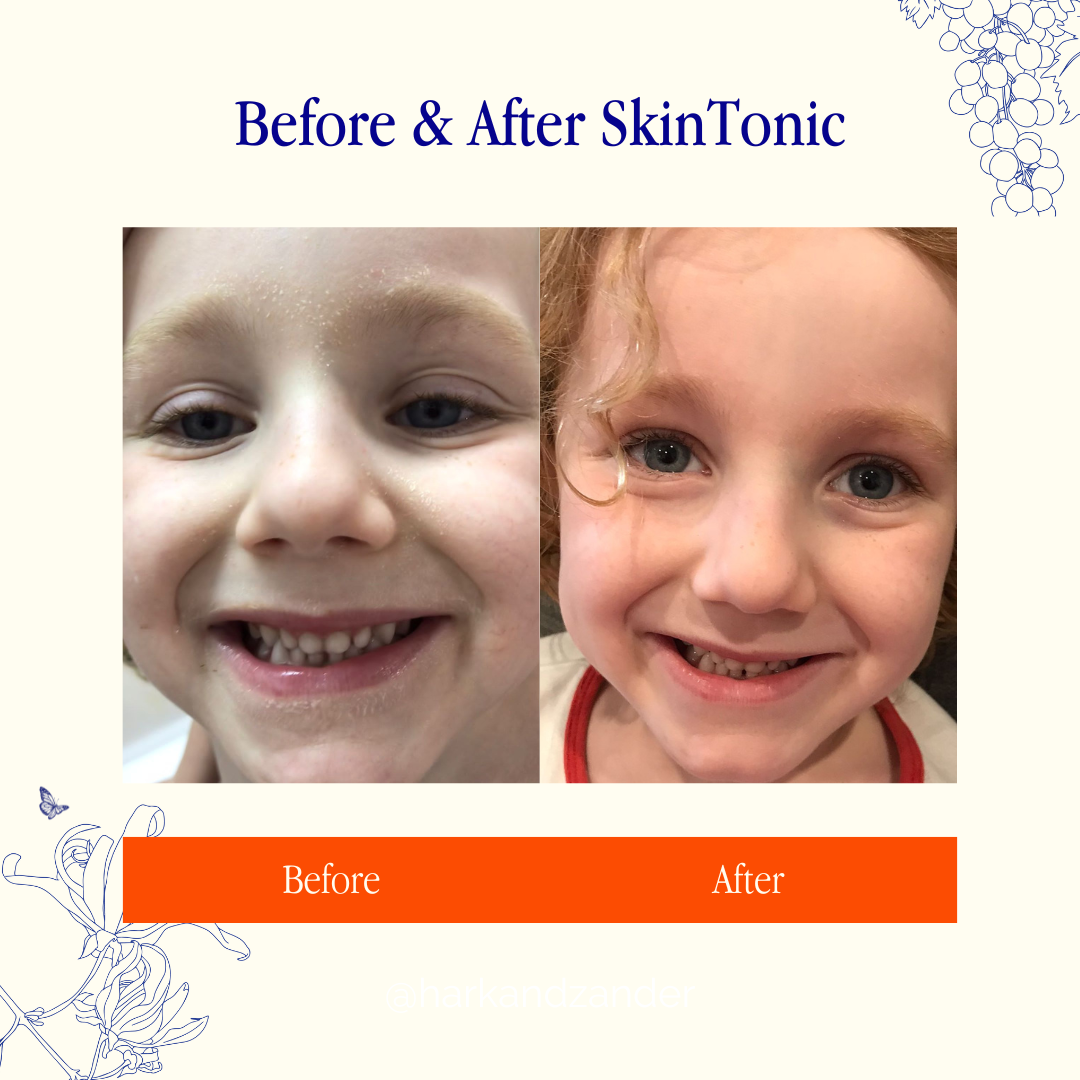 How to treat dry, damaged skin. See the results for yourself!
