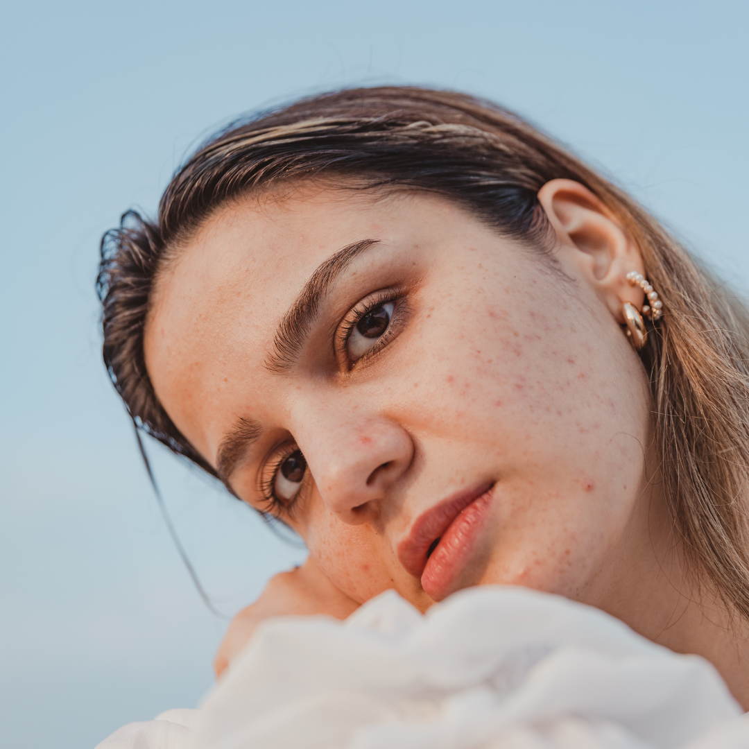 Nurturing Your Skin: Managing Adult Acne with Nature's Best Ingredients