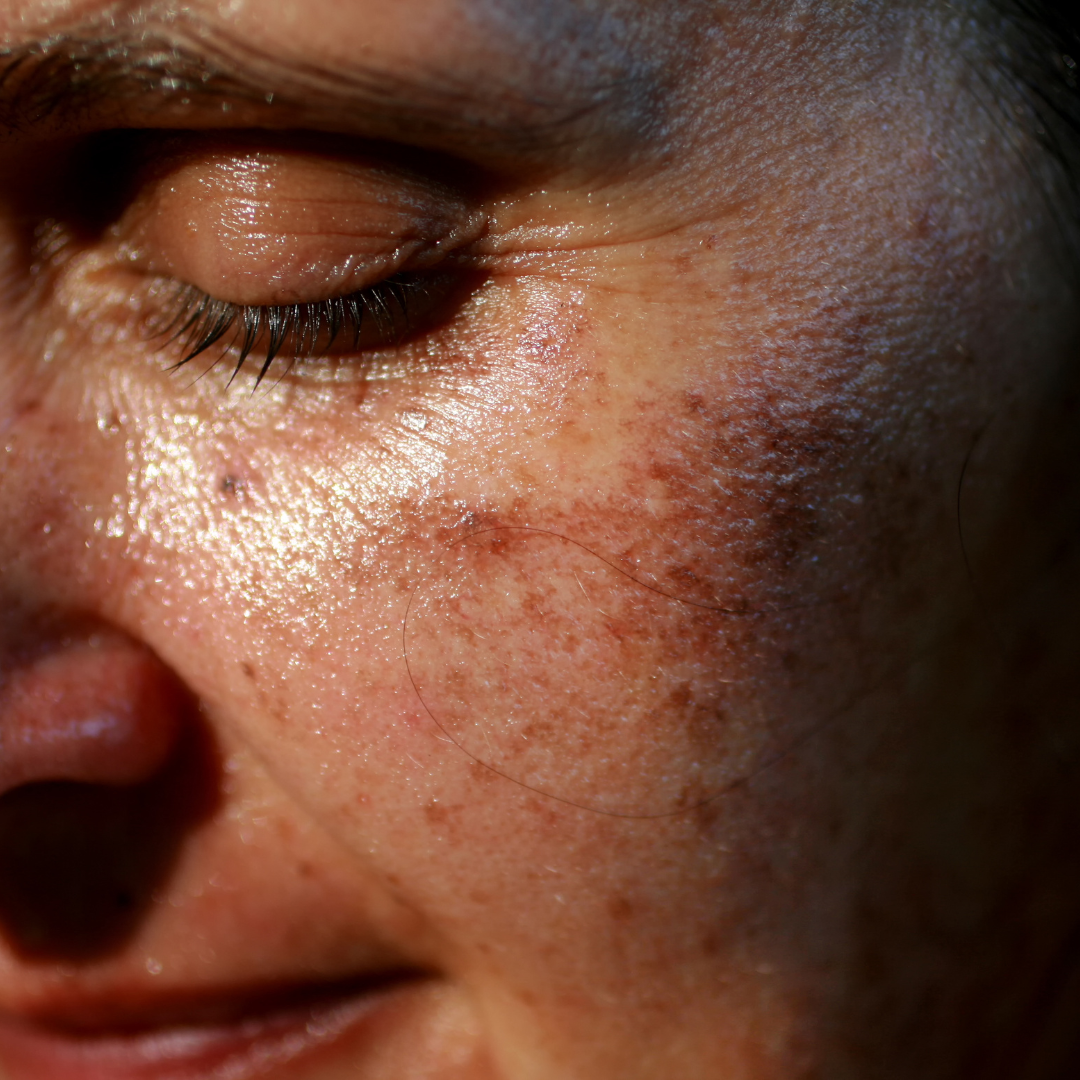 Rosacea: Causes and Symptom Management