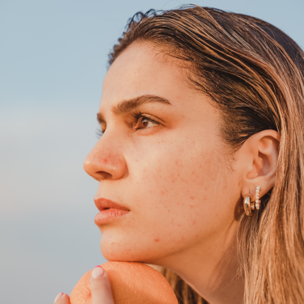 Nurturing Your Skin: Skincare Tips for Acne-Prone Skin with Hark & Zander